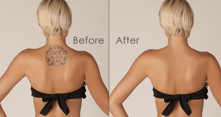 Best and Effective Yet Pain-Free Tattoo Removal in Orlando